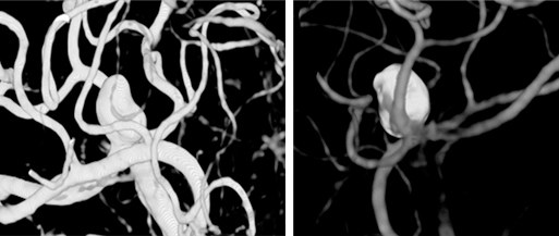 뇌동맥류 철사를 이용한 폐색술 사진