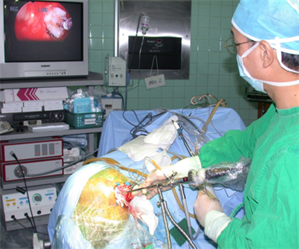 내시경을 이용한 뇌 흡인술 사진