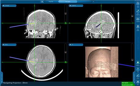 네비게이션을 이용한 뇌출혈 제거술 사진