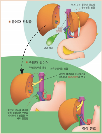공여자의 간적출 이후 수혜자 간이식 절차