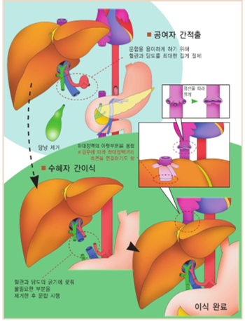 공여자의 간적출 이후 수혜자 간이식 절차