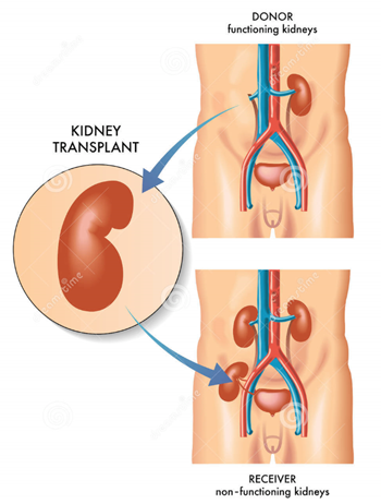 공여자의 신장적출 이후 수혜자 신장이식 절차