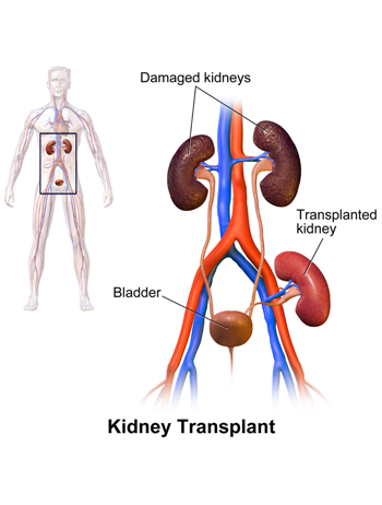 공여자의 신장적출 이후 수혜자 신장이식 절차