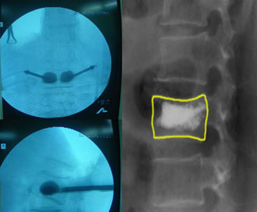 척추성형술 수술 후 사진