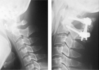 환축추 아탈구 수술 전/후 X-ray 