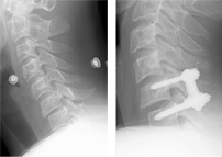 경추골절 및 탈구 수술 전/후 X-ray 