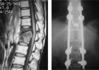 결핵성척추염 수술 전/후 X-ray 