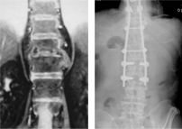화농성 척추염 수술 전/후 X-ray 