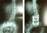 선천성 척추 기형 수술 전/후 X-ray 
