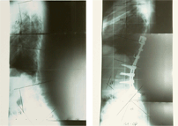 척추 후만증 수술 전/후 X-ray 