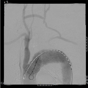 머리혈관 우회술