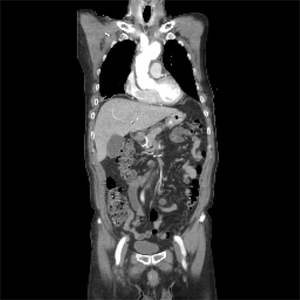 인조혈관 대치술 후 CT