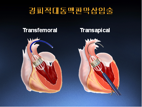 경피적 대동맥판막삽입술 그림